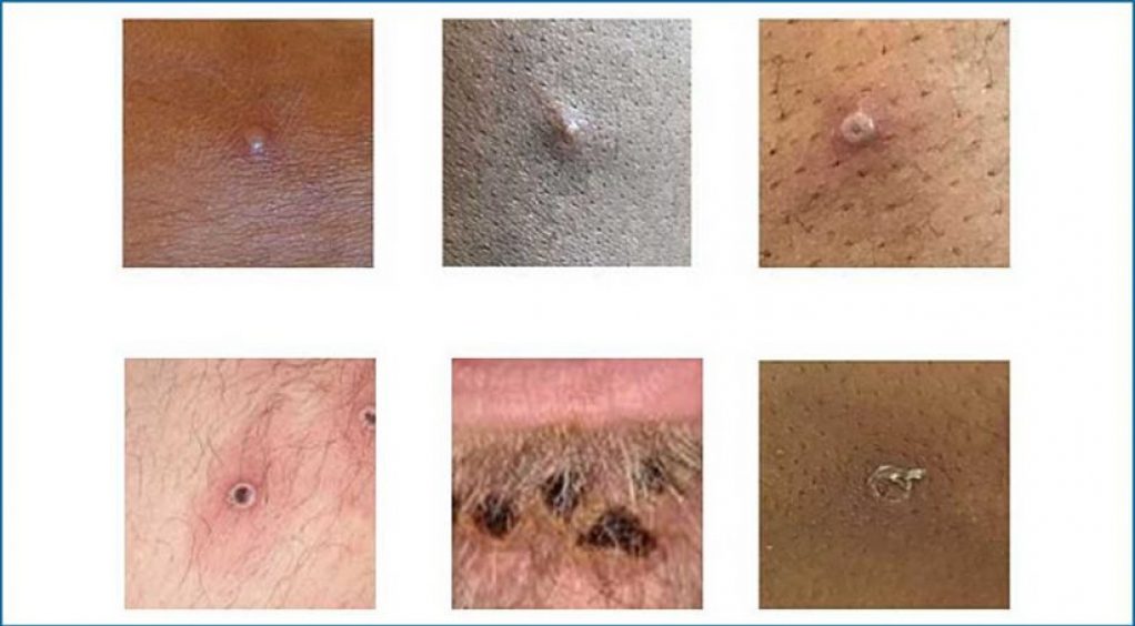 Monkey Pox Types
